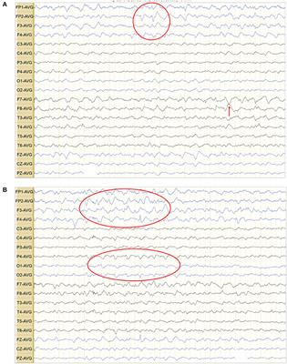 Association Between Late-Onset Leukoencephalopathy With Vanishing White Matter and Compound Heterozygous EIF2B5 Gene Mutations: A Case Report and Review of the Literature